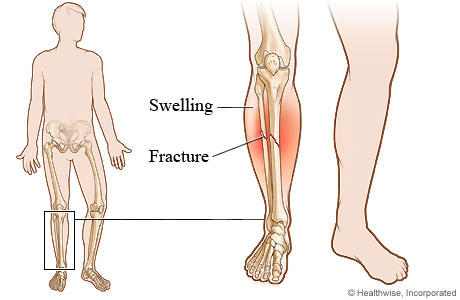 Picture of a lower leg fracture